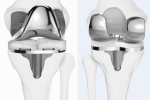 Could Joint Preservation Change How South Africa Treats Osteoarthritis?