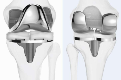 Could Joint Preservation Change How South Africa Treats Osteoarthritis?