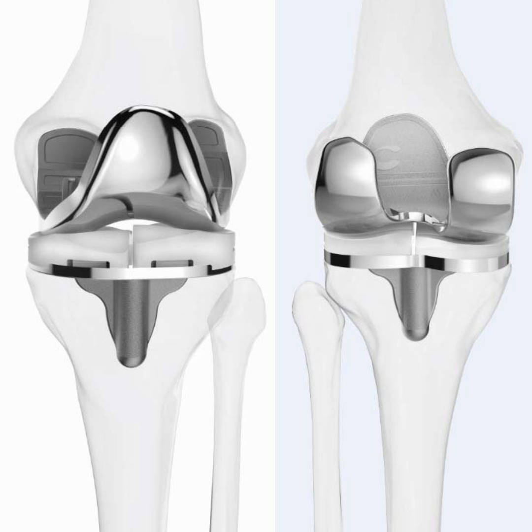 Could Joint Preservation Change How South Africa Treats Osteoarthritis?